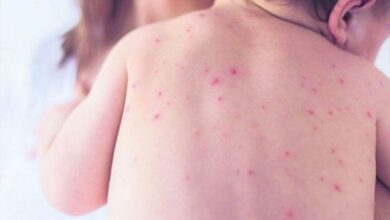 Na području FBiH registrirano 7456 slučajeva morbila