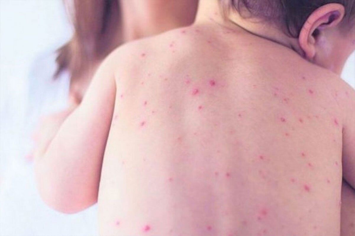 Na području FBiH registrirano 7456 slučajeva morbila